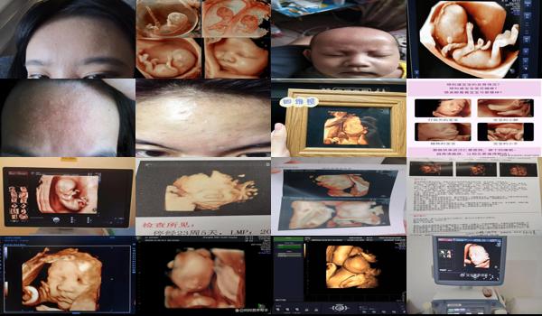 四維彩超胎兒額頭有疙瘩 - 汕頭四維胎兒額頭有疙瘩